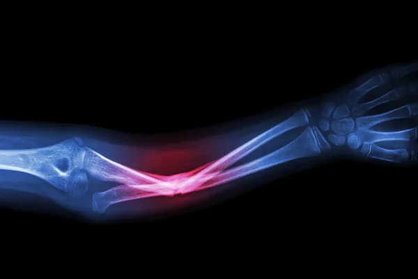 X-ray fracture ulnar bone (forearm bone) — Stock Photo, Image