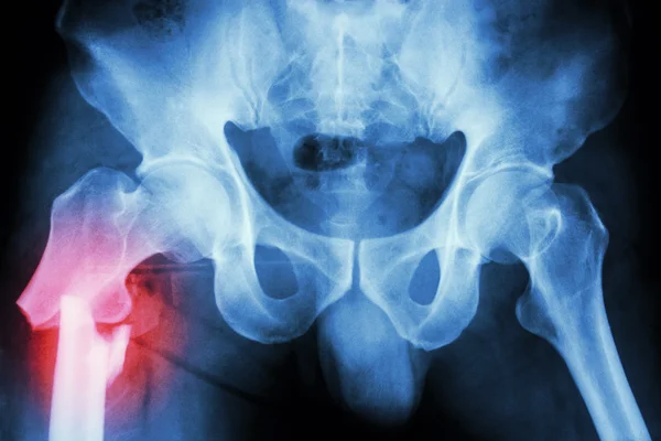 Fracture right femur (thigh's bone) — Stock Photo, Image