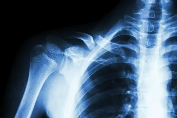 Fracture right clavicle — Stock Photo, Image