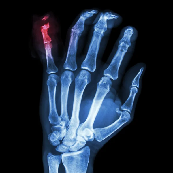 Fracture distal pharange little finger — Stock Photo, Image