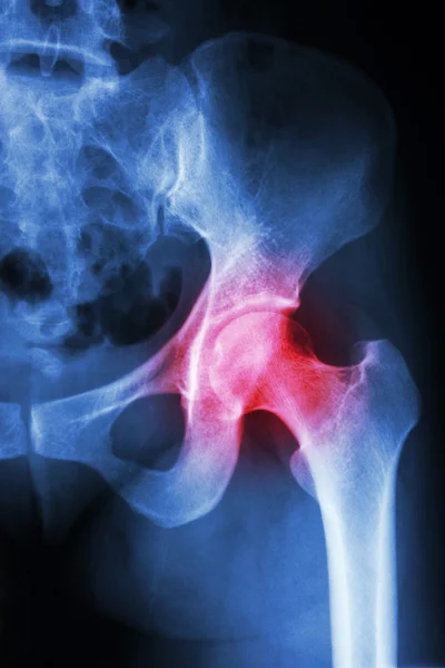 X-ray left hip and arthritis left hip — Stock Photo, Image