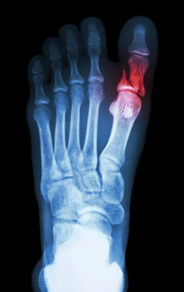 Fracture proximal phalange at first toe — Stock Photo, Image