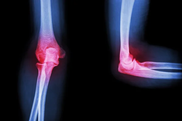 Film X-ray elleboog met artritis (reumatoïde, jicht) — Stockfoto