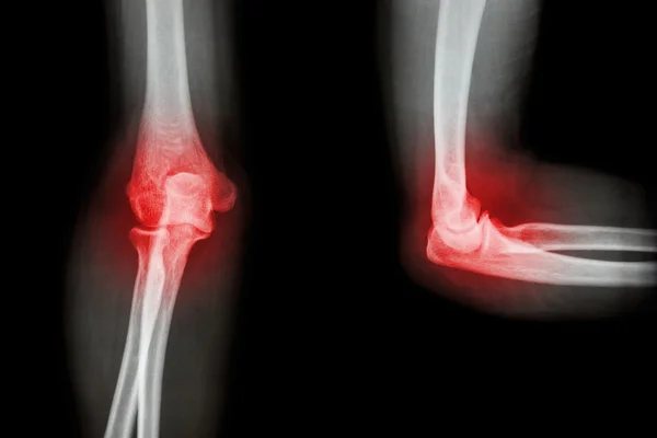 Фільм рентгенівського лікоть з артритом (ревматоїдний, подагри) — стокове фото