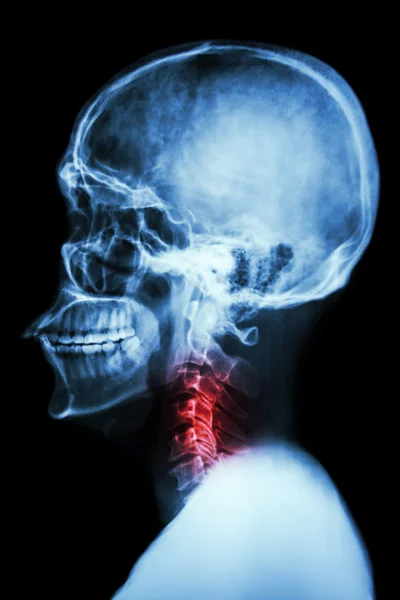 X 射线亚洲头骨和颈椎的脊椎和颈部疼痛 — 图库照片