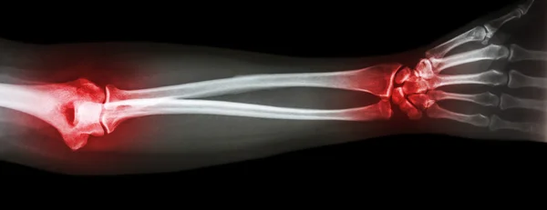 Рентген предплечья с артритом на запястье и локте (Ревматоид, подагра ) — стоковое фото
