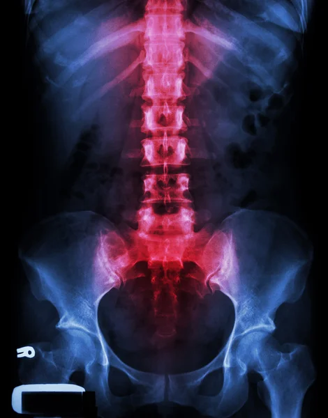 X-Ray lumbo-sacrale wervelkolom en bekken en ontsteking op rug — Stockfoto