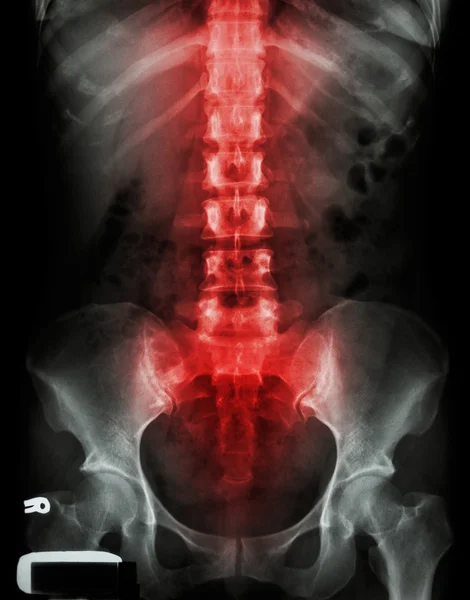X-Ray lumbo-sacrale wervelkolom en bekken en ontsteking op rug — Stockfoto