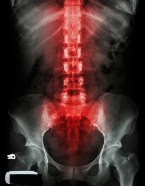 Radiografía de columna lumbo-sacra y pelvis e inflamación en la columna vertebral — Foto de Stock