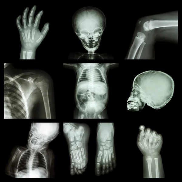 Kolekce x-ray část těla dítěte — Stock fotografie