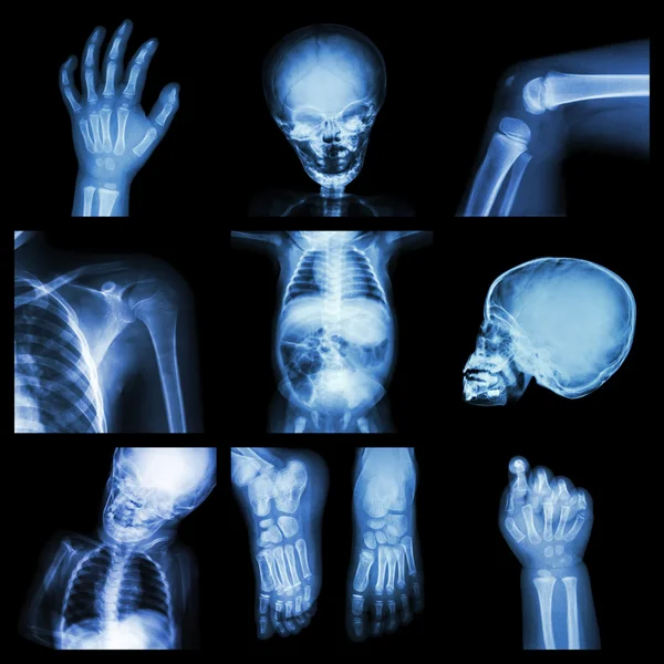 Collection x-ray part of child body — Stock Photo, Image