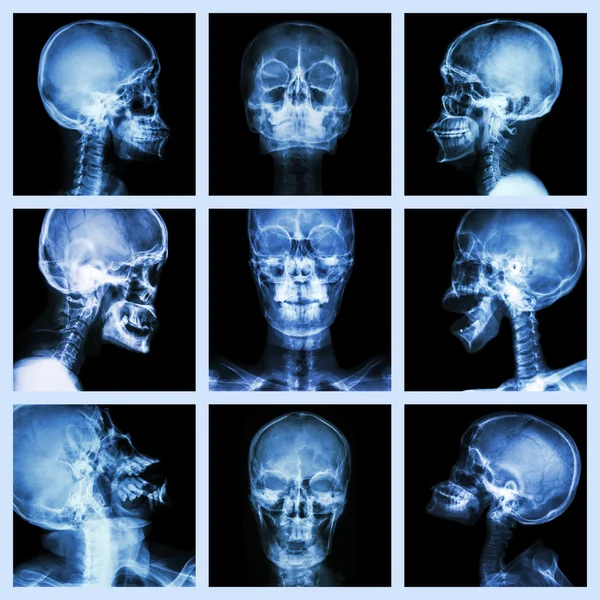 Collection of asian skull (Thai people) — Stock Photo, Image