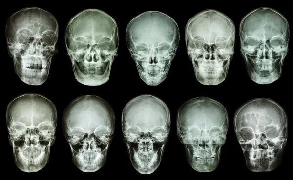 Collection of asian skull (anterior view) (Thai people) — Stock Photo, Image