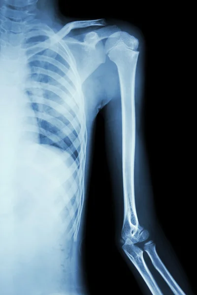 Filme raio-x ombro esquerdo — Fotografia de Stock