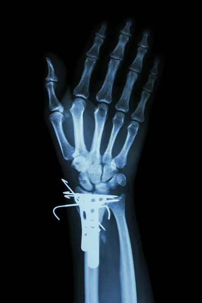 Fracture distal radius (forearm's bone). It was operated and ins — Stock Photo, Image