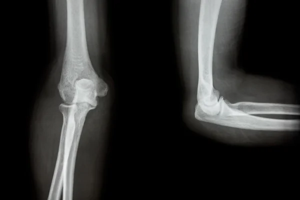 Ταινία X-ray αγκώνα Ap(Antero-posterior) στεγών, πλευρικός — Φωτογραφία Αρχείου