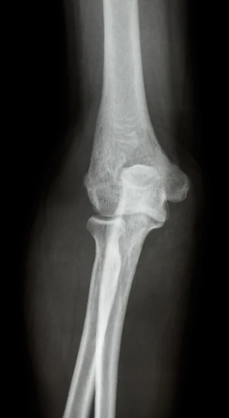 Ταινία X-ray αγκώνα Ap(Antero-posterior) στεγών, πλευρικός — Φωτογραφία Αρχείου