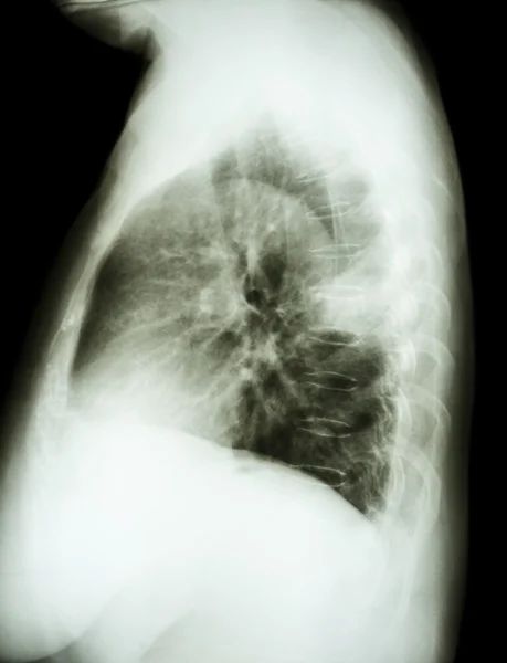 肺癌病人 x 线胸部外侧 — 图库照片