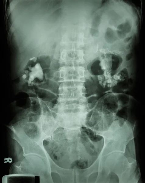 Bilateral renal calculi(staghorn) — Stock Photo, Image