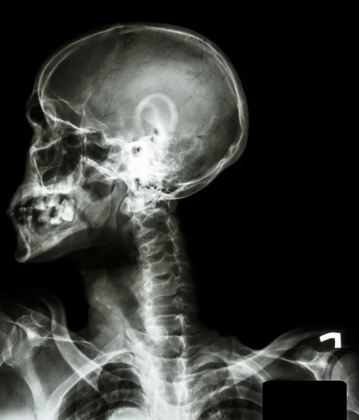 X-ray asiatiska skalle (thailändska folket), halsryggen, både skuldra och — Stockfoto