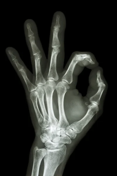 X-ray hand with OK symbol — Stock Photo, Image