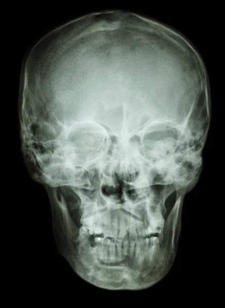 Normalne ludzkie czaszki — Zdjęcie stockowe