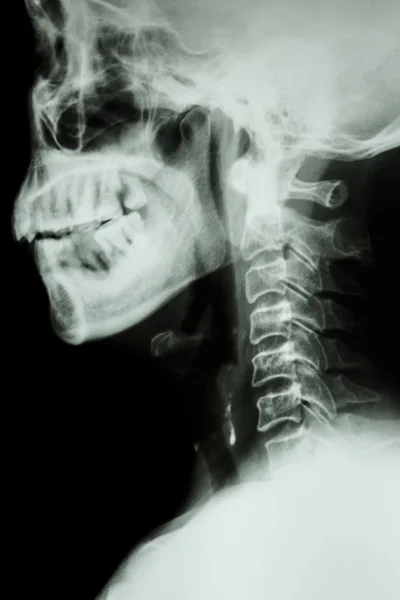 Raggi X cervicale colonna vertebrale di asiatici — Foto Stock