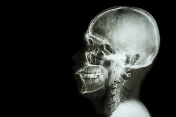 X-ray cranio asiatico e spazio vuoto sul lato sinistro — Foto Stock