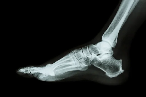 X-ray normal foot lateral — Stock Photo, Image