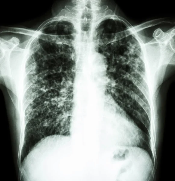 Tuberculose pulmonar — Fotografia de Stock