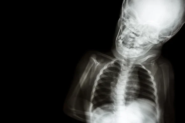 X-ray tělo dítěte a prázdné oblasti v levé straně — Stock fotografie