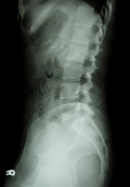 X-ray lumbo-sacral spine (lateral) of asian adult people — Stock Photo, Image