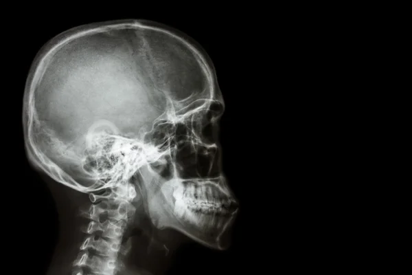 X-ray asian skull (Thai people) and blank area at right side — Stock Photo, Image