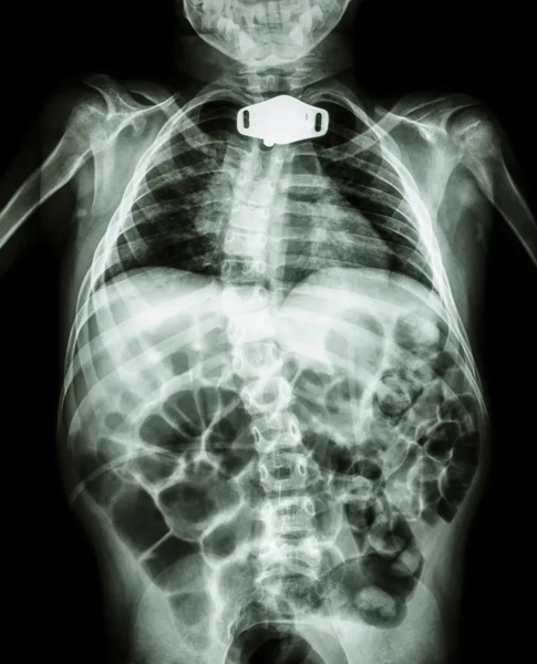 Çocuk ve trakeostomi tüpü gövdesini x-ışını — Stok fotoğraf