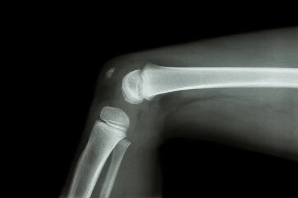 Film x-ray knee lateral of child — Stock Photo, Image