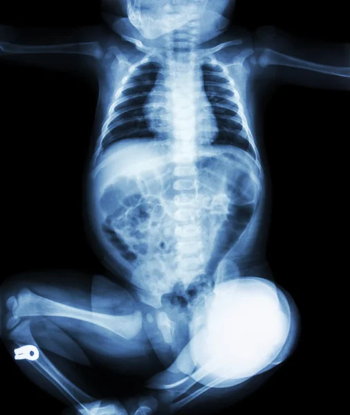 Criança de raio-X está sentada — Fotografia de Stock