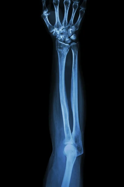 Fracture distal radius (wrist bone) ,(Colles' fracture) — Stock Photo, Image