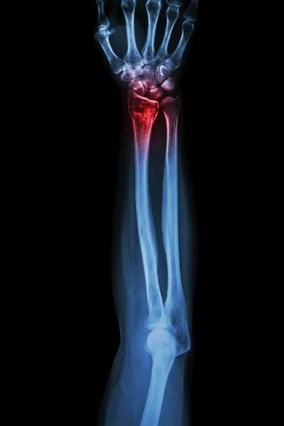 Fracture distal radius (wrist bone) ,(Colles' fracture) — Stock Photo, Image