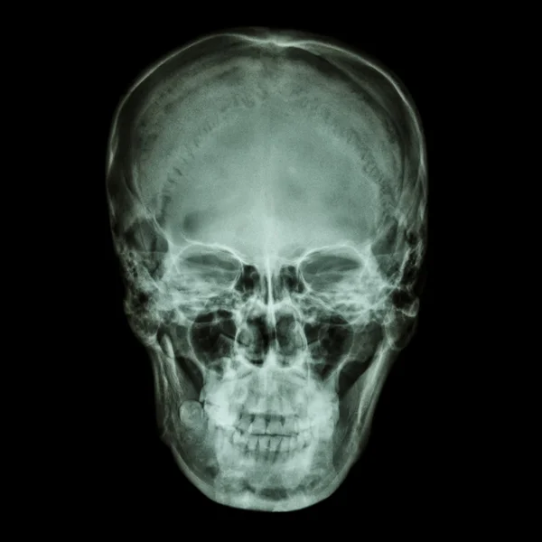 Raios-X normal asiático crânio (tailandês pessoas ) — Fotografia de Stock