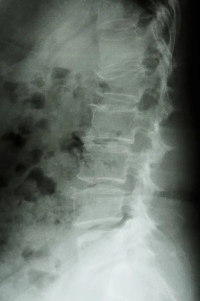 薄膜 x 射线腰椎侧: 显示腰椎爆裂性骨折 — 图库照片