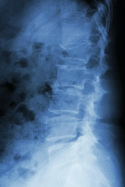 Film x-ray lumbar spine lateral : show burst fracture at lumbar — Stock Photo, Image