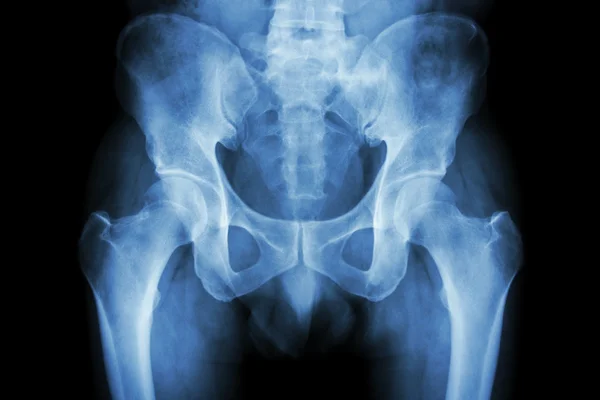 Film x-ray normal pelvis — Stock Photo, Image