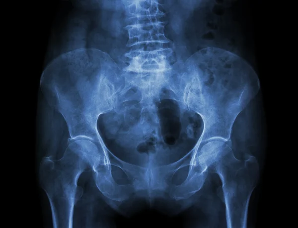 Film x-ray bekken van osteoporose patiënt — Stockfoto