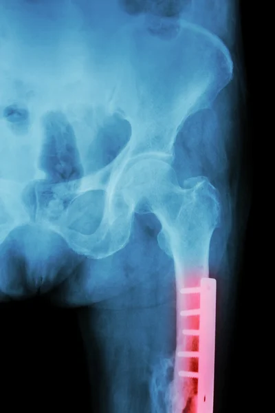 Film X-ray fracture femur(Thigh bone). It was operated and inter — Stock Photo, Image