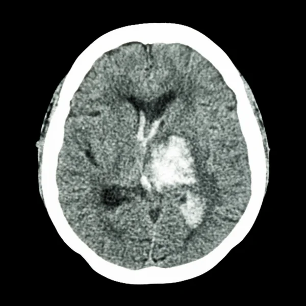 TAC cerebral: muestra hemorragia talámica izquierda (accidente cerebrovascular hemorrágico) ) — Foto de Stock