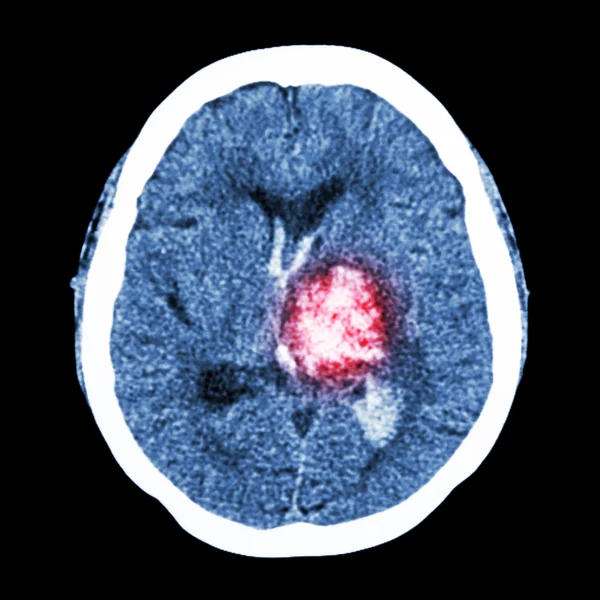 Cérebro CT: mostrar hemorragia talâmica esquerda (AVC hemorrágico ) — Fotografia de Stock