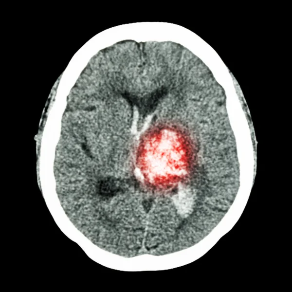 TAC cerebral: muestra hemorragia talámica izquierda (accidente cerebrovascular hemorrágico) ) —  Fotos de Stock