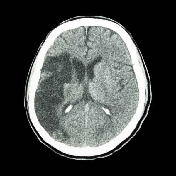 Cérebro CT: mostrar acidente vascular cerebral isquêmico (hipodensidade à direita frontal-pa — Fotografia de Stock