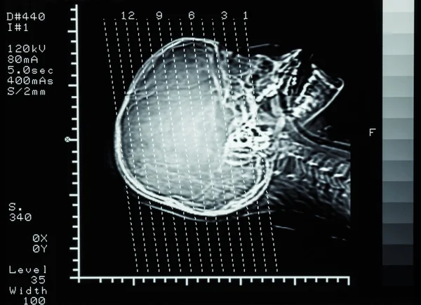 Film CT scan (Computed tomography) brain : show section line on — Stock Photo, Image