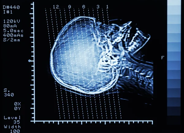 Film TAC (Tomografia computerizzata) cervello: mostra la linea di sezione su — Foto Stock